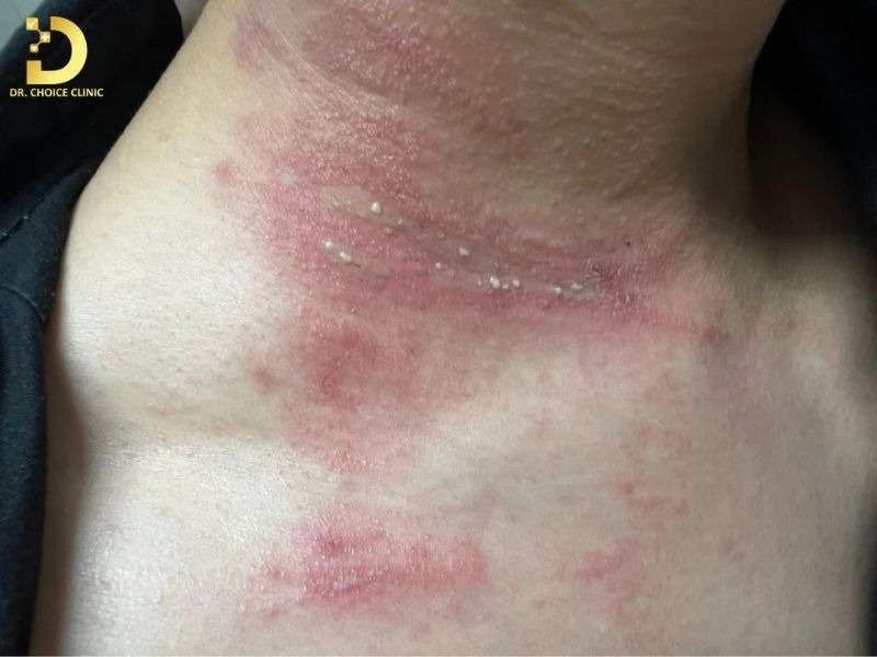 Top Bệnh Về Da Mùa Hè Thường Gặp & Cách Phòng Ngừa Hiệu Quả 41 Viêm da tiếp xúc do kiến ba khoang