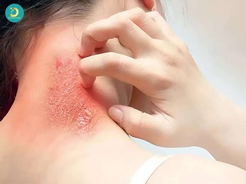 Các Bệnh Nhiễm Trùng Da Thường Gặp: Nguyên Nhân, Dấu Hiệu Và Cách Điều Trị 17 Những yếu tố làm tăng nguy cơ nhiễm trùng da