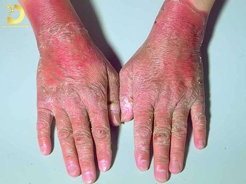 Top Bệnh Về Da Mùa Hè Thường Gặp & Cách Phòng Ngừa Hiệu Quả 39 Pellagra