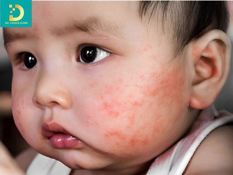 Viêm Da Tiếp Xúc Ở Trẻ Em: Nguyên Nhân, Biểu Hiện & Cách Điều Trị Hiệu Quả 11 Viêm da tiếp xúc ở trẻ em có biểu hiện dễ nhầm lẫn với nhiều bệnh da liễu khác