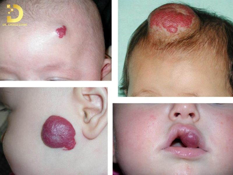 U Máu Ở Trẻ Em: Nguyên Nhân, Biểu Hiện, Khi Nào Cần Can Thiệp Điều Trị? 11 U máu được phân loại dựa trên độ sâu, phân bố và vị trí
