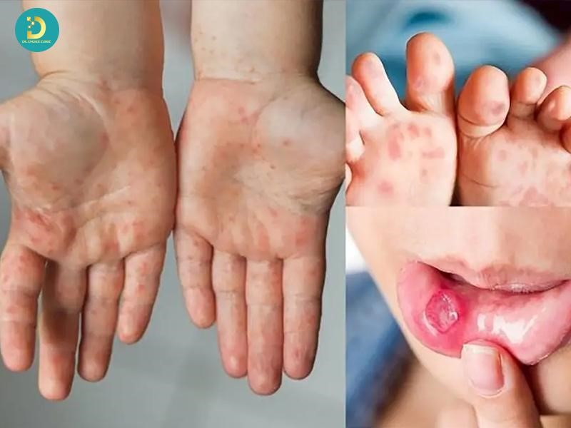 Các Loại Phát Ban Ở Trẻ: Cách Phân Biệt & Xử Lý Hiệu Quả 18 Phát ban do bệnh truyền nhiễm ở trẻ em