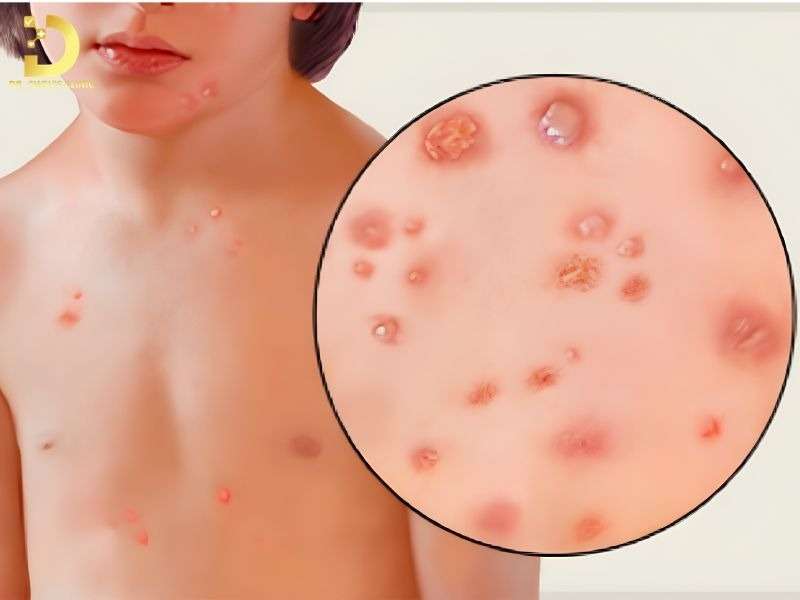 Top Bệnh Về Da Mùa Hè Thường Gặp & Cách Phòng Ngừa Hiệu Quả 23 Thủy đậu