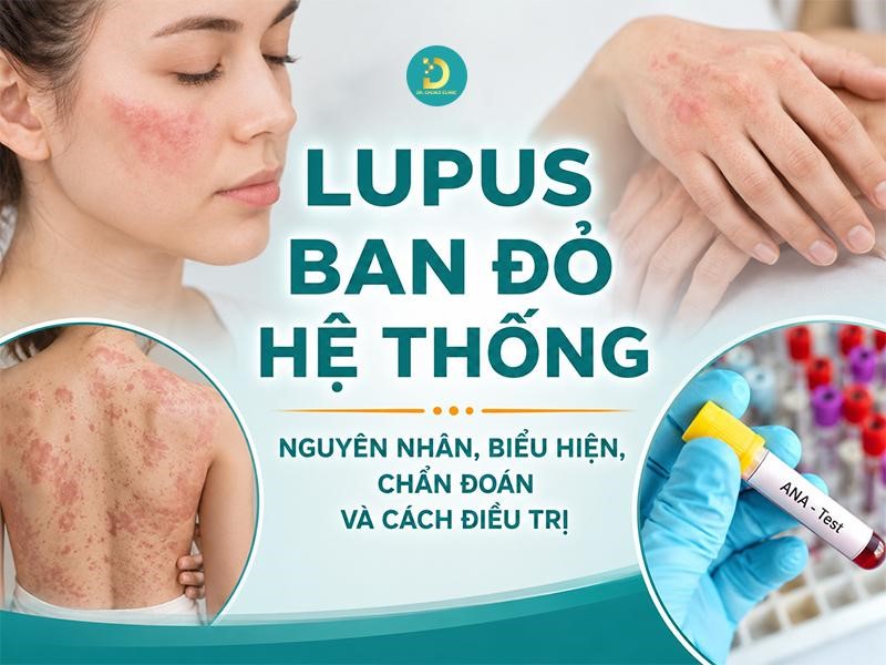 Lupus Ban Đỏ Hệ Thống: Nguyên Nhân, Biểu Hiện, Chẩn Đoán Và Cách Điều Trị 8 Tìm hiểu bệnh Lupus ban đỏ hệ thống
