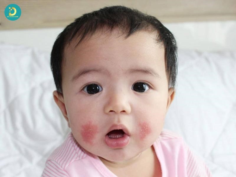 Viêm Da Cơ Địa Ở Trẻ Em: Dấu Hiệu Và Phác Đồ Điều Trị 9 Viêm da cơ địa trẻ em (hay còn gọi là chàm thể tạng, chàm sữa, eczema) là bệnh da liễu mạn tính rất phổ biến