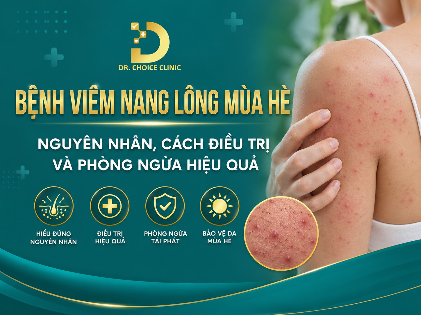 Bệnh Viêm Nang Lông Mùa Hè: Nguyên Nhân, Cách Điều Trị Và Phòng Ngừa Hiệu Quả 8 Tìm hiểu chi tiết bệnh viêm nang lông mùa hè