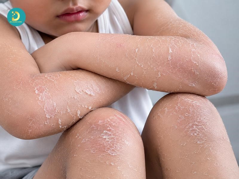 Bệnh Vảy Cá Ở Trẻ Em: Nguyên Nhân, Triệu Chứng & Cách Điều Trị Hiệu Quả 14 Vị trí thường xuất hiện bệnh vảy cá trẻ em