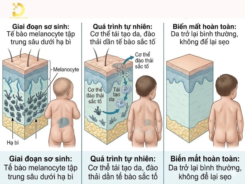 Vết Bớt Mông Cổ Ở Trẻ Sơ Sinh Có Tự Hết Không? 11 Vết bớt Mông Cổ thường tự mờ dần theo thời gian