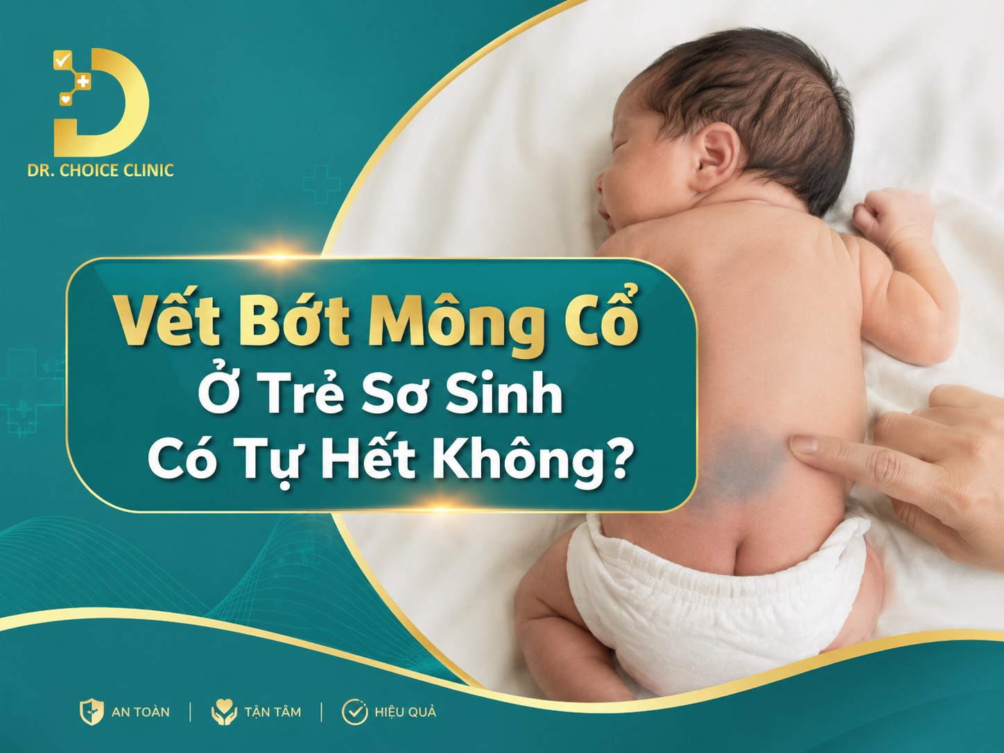 Vết Bớt Mông Cổ Ở Trẻ Sơ Sinh Có Tự Hết Không? 8 Tìm hiểu về vết bớt mông cổ ở trẻ sơ sinh