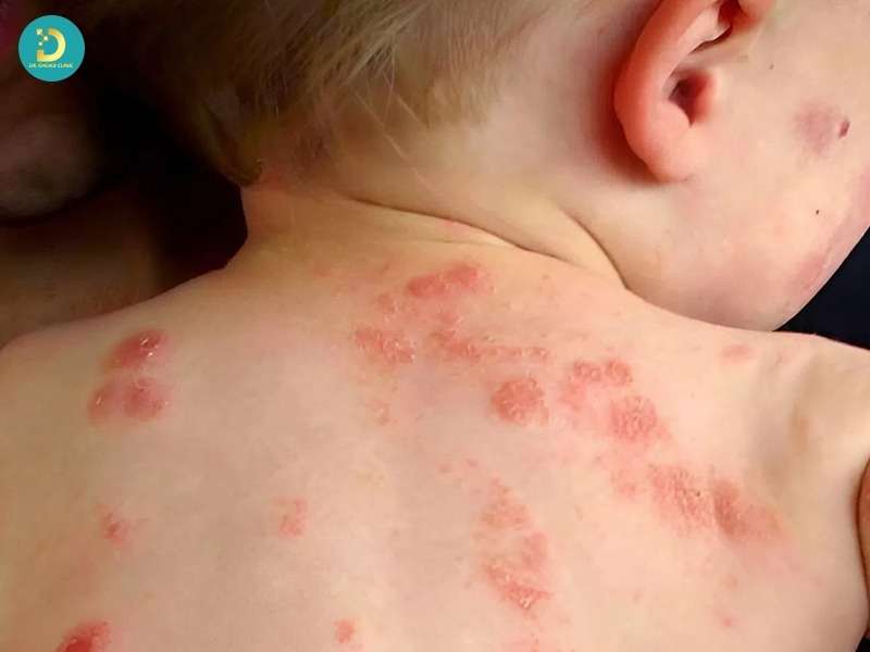 Bệnh Chốc Lở: Nguyên Nhân, Dấu Hiệu, Cách Điều Trị Và Phòng Ngừa Bệnh 14 Vì sao trẻ nhỏ dễ bị chốc lở hơn người lớn?