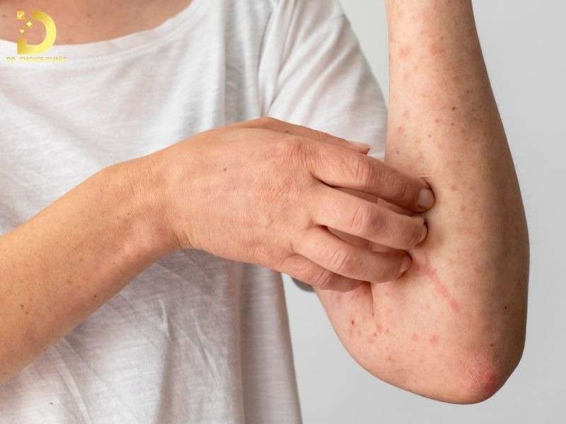 Top Bệnh Về Da Mùa Hè Thường Gặp & Cách Phòng Ngừa Hiệu Quả 36 Viêm da cơ địa
