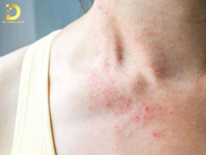 Top Bệnh Về Da Mùa Hè Thường Gặp & Cách Phòng Ngừa Hiệu Quả 35 Viêm da tiết bã