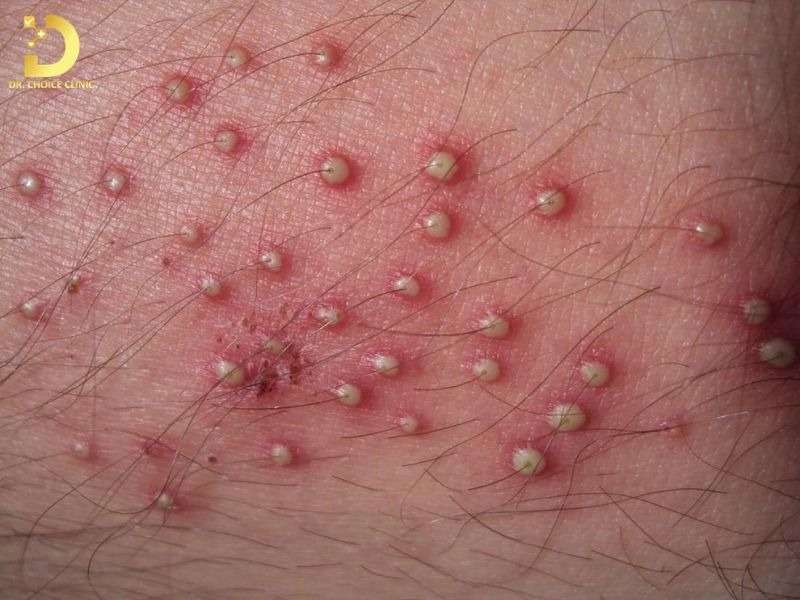 Top Bệnh Về Da Mùa Hè Thường Gặp & Cách Phòng Ngừa Hiệu Quả 27 Viêm nang lông