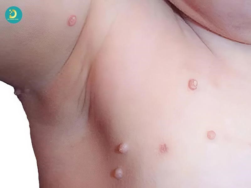 Bệnh U Mềm Lây Ở Trẻ Em: Nguyên Nhân, Biểu Hiện, Cách Điều Trị An Toàn 11 Bệnh u mềm lây ở trẻ em (ảnh minh họa)