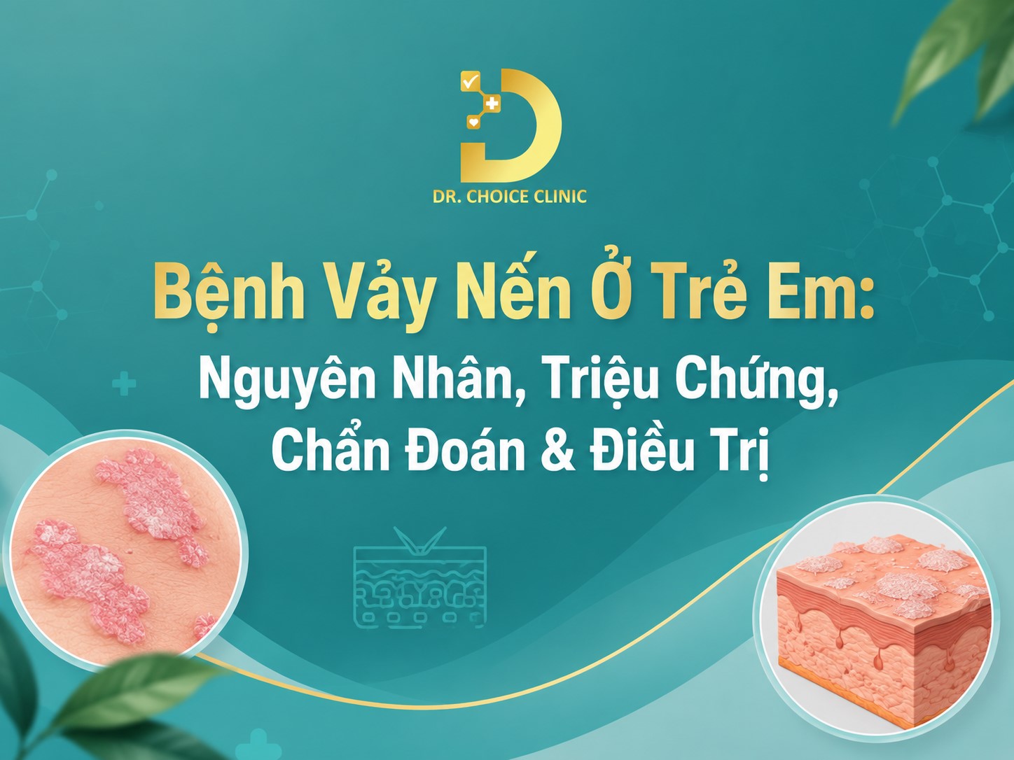 Bệnh Vảy Nến Ở Trẻ Em: Nguyên Nhân, Triệu Chứng, Chẩn Đoán & Điều Trị 8 Tìm hiểu bệnh vảy nến ở trẻ em: nguyên nhân, triệu chứng và điều trị