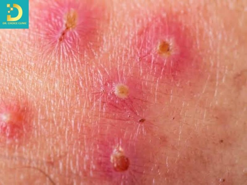 Trẻ Bị Hăm Tã Nặng: Dấu Hiệu Nhiễm Khuẩn Và Cách Điều Trị An Toàn 15 Dấu hiệu gợi ý bội nhiễm vi khuẩn