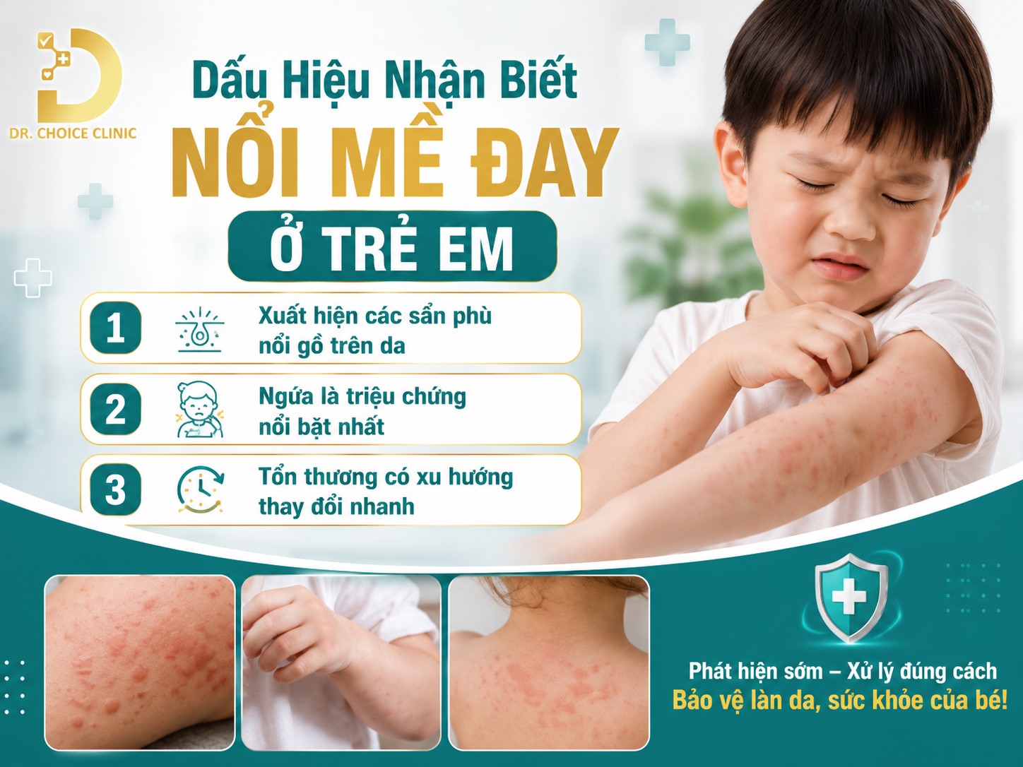 Nổi Mề Đay Ở Trẻ Em Có Nguy Hiểm Không? Cách Điều Trị Và Phòng Ngừa 9 Dấu hiệu nhận biết nổi mề đay ở trẻ em