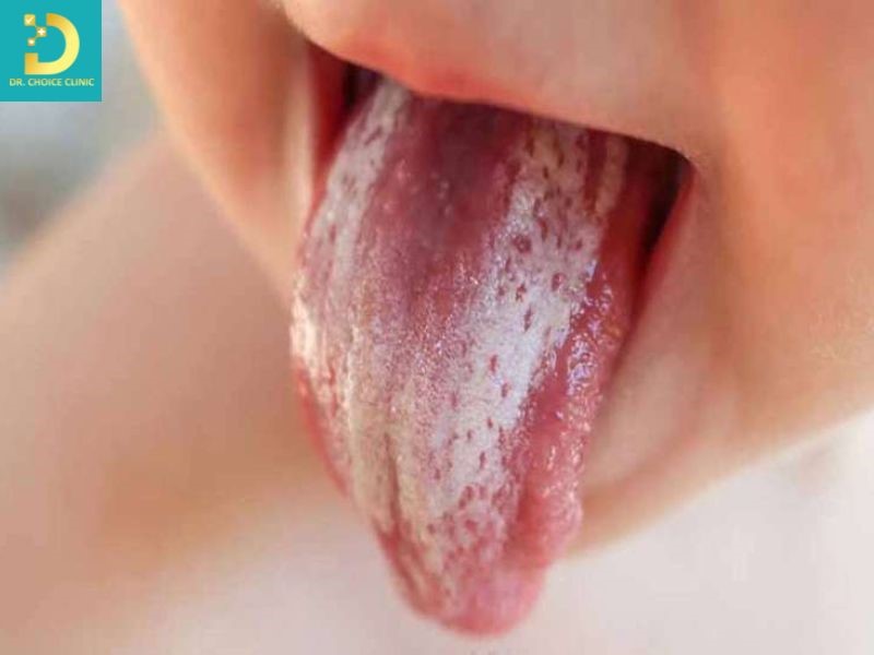 Trẻ Bị Hăm Tã Nặng: Dấu Hiệu Nhiễm Khuẩn Và Cách Điều Trị An Toàn 14 Dấu hiệu gợi ý bội nhiễm nấm Candida