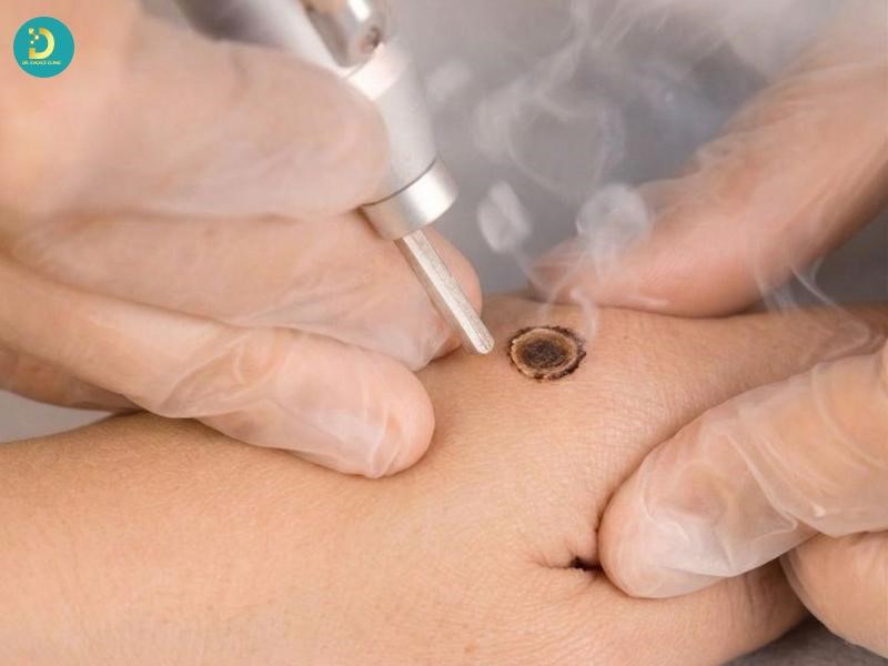 Mụn Cóc Ở Trẻ Em: Nguyên Nhân, Biểu Hiện & Cách Điều Trị An Toàn 16 Điều trị mụn cóc bằng các phương pháp y khoa
