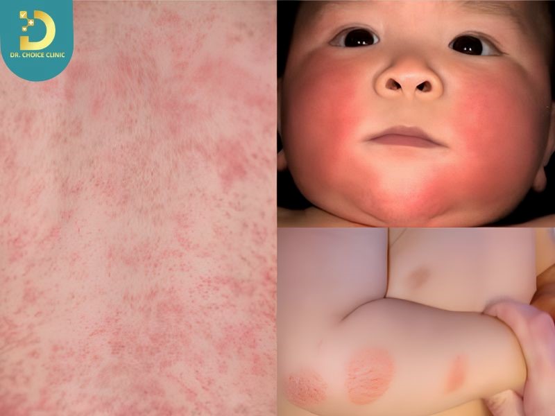 Nổi Mề Đay Ở Trẻ Em Có Nguy Hiểm Không? Cách Điều Trị Và Phòng Ngừa 8 Trẻ em bị mề đay (ảnh minh họa)