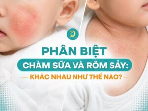 Phân biệt chàm sữa và rôm sảy ở trẻ em