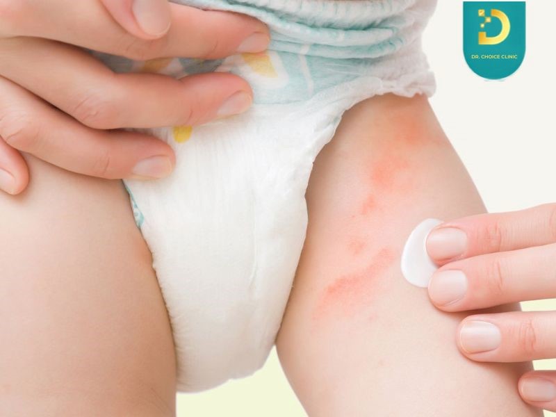 Trẻ Bị Hăm Tã Nặng: Dấu Hiệu Nhiễm Khuẩn Và Cách Điều Trị An Toàn 19 Bệnh ghẻ và chốc lở ở trẻ (ảnh minh họa)