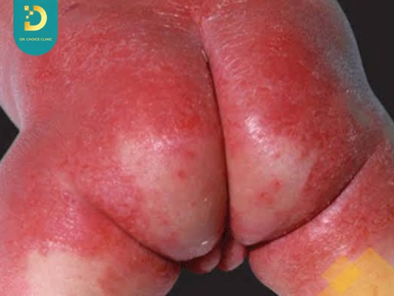 Trẻ Bị Hăm Tã Nặng: Dấu Hiệu Nhiễm Khuẩn Và Cách Điều Trị An Toàn 18 Viêm da tiết bã ở trẻ nhũ nhi (ảnh minh họa)