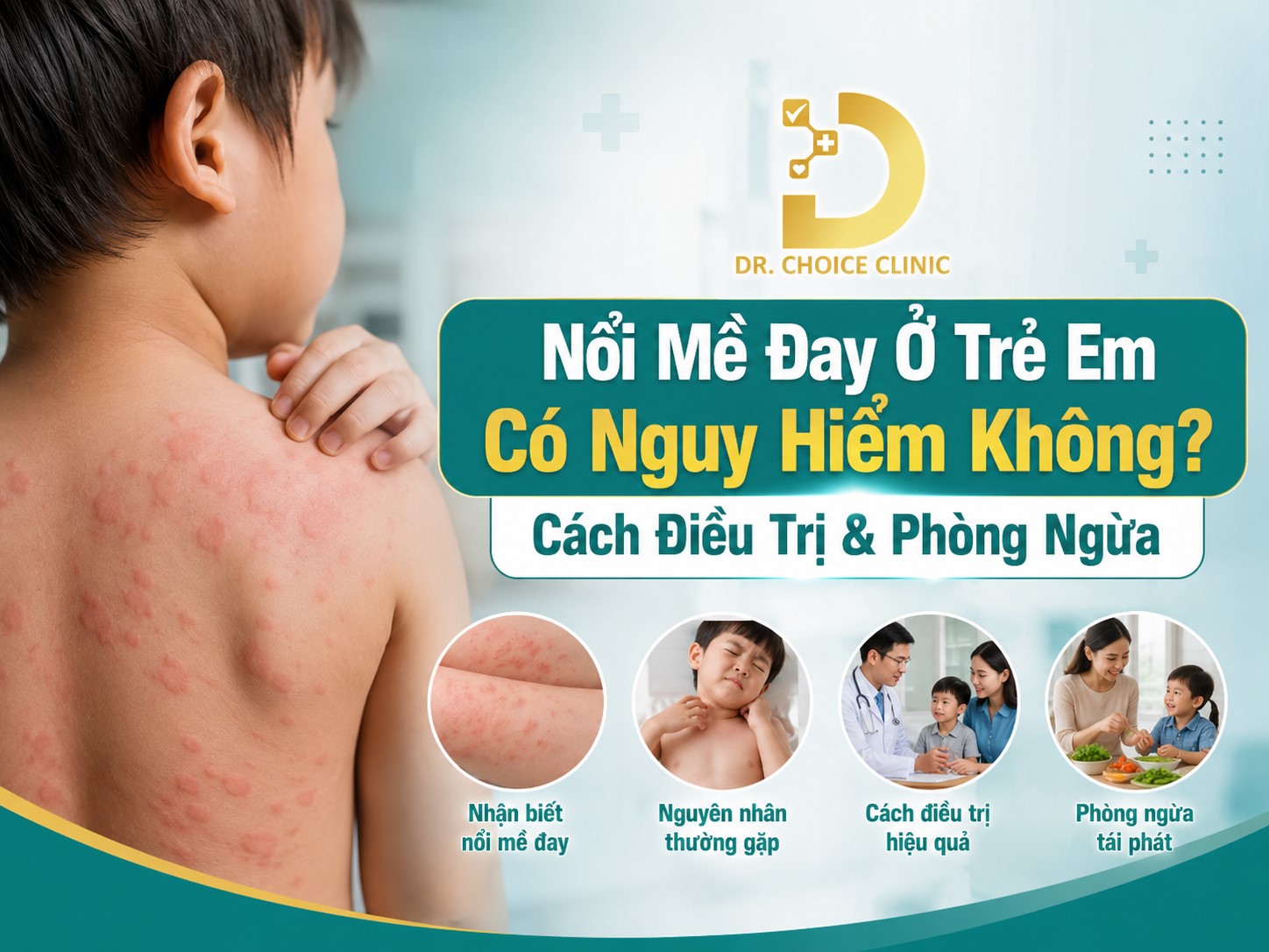 Nổi Mề Đay Ở Trẻ Em Có Nguy Hiểm Không? Cách Điều Trị Và Phòng Ngừa 7 Tìm hiểu về mề đay ở trẻ em