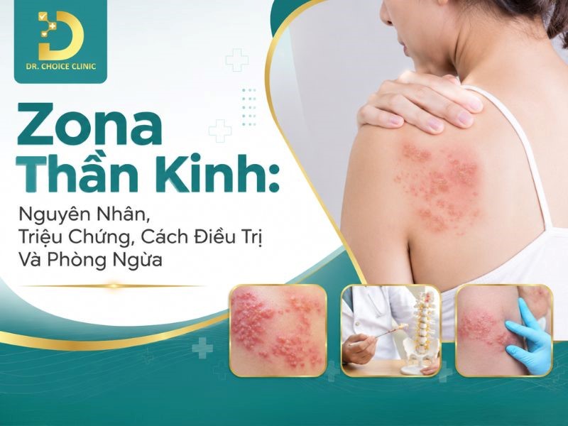 Zona Thần Kinh: Nguyên Nhân, Triệu Chứng, Cách Điều Trị Và Phòng Ngừa 8 Tìm hiểu về Zona thần kinh