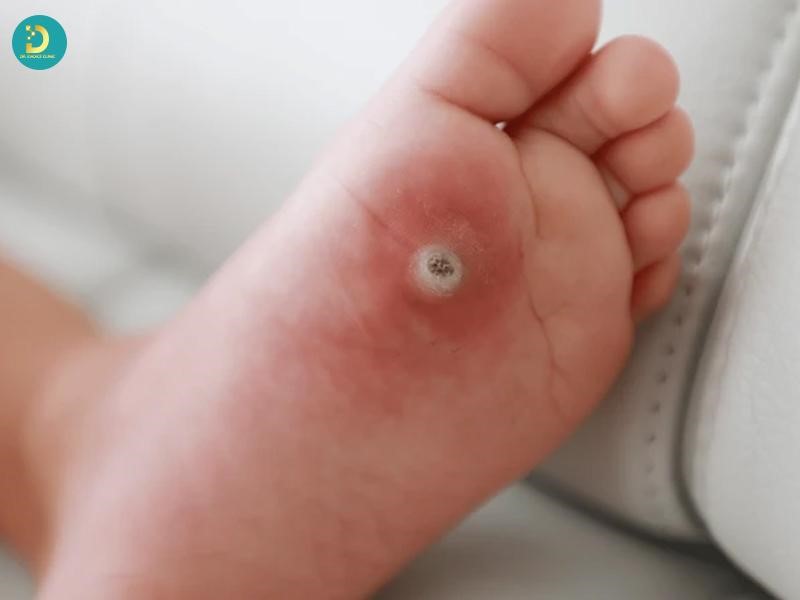 Mụn Cóc Ở Trẻ Em: Nguyên Nhân, Biểu Hiện & Cách Điều Trị An Toàn 14 Dấu hiệu nhận biết trẻ em bị mụn cóc