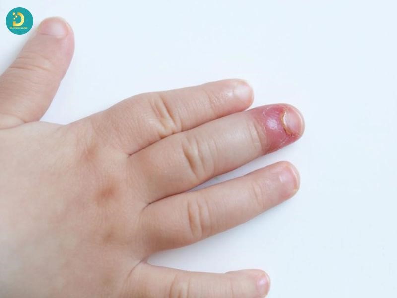 Mụn Cóc Ở Trẻ Em: Nguyên Nhân, Biểu Hiện & Cách Điều Trị An Toàn 13 Trẻ em đối tượng dễ bị mụn cóc
