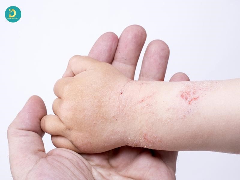 Bệnh U Mềm Lây Ở Trẻ Em: Nguyên Nhân, Biểu Hiện, Cách Điều Trị An Toàn 13 Da bị trầy xước làm tăng nguy cơ lây bệnh