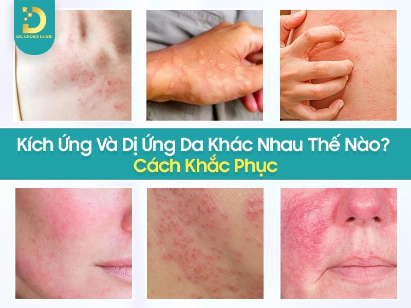 Kích Ứng Và Dị Ứng Da Khác Nhau Thế Nào? Cách Khắc Phục 8 Tìm hiểu kích ứng da và dị ứng da
