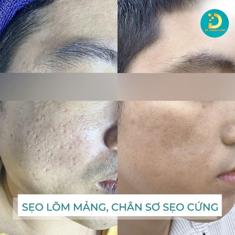 Tiêu Chí Lựa Chọn Spa Chăm Sóc, Điều Trị Da 24 Hình ảnh điều trị sẹo lõm mảng với chân sẹo cứng.