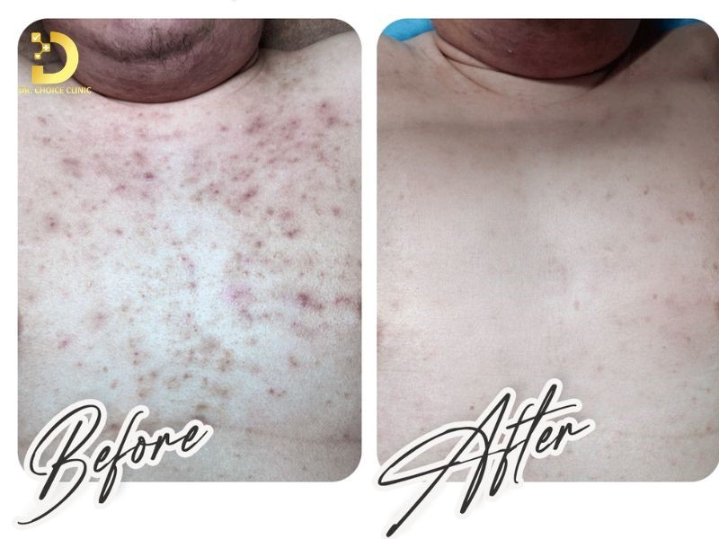 Tiêu Chí Lựa Chọn Spa Chăm Sóc, Điều Trị Da 27 Feedback của khách hàng sử dụng dịch vụ điều trị mụn thâm.