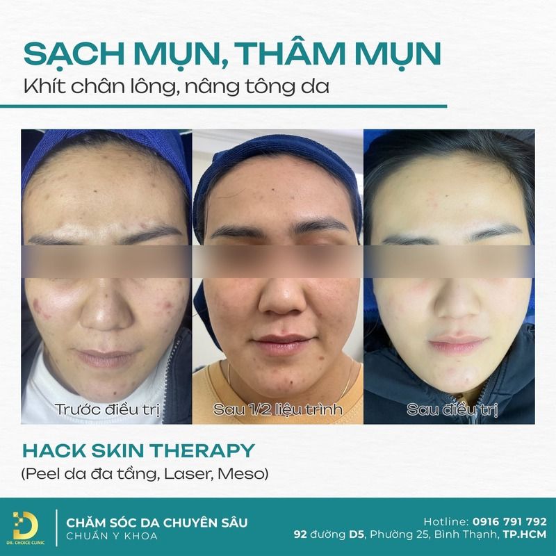 Mesotherapy Điều Trị Da Là Gì? Đặc Điểm, Ứng Dụng & Lưu Ý 15 Hình ảnh Meso điều trị da tại Dr Choice