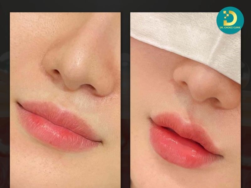 Tiêu Chí Lựa Chọn Spa Chăm Sóc, Điều Trị Da 26 Feedback của khách hàng sử dụng dịch vụ tiêm filler.