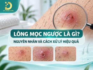 Tìm hiểu tổng quan về tình trạng lông mọc ngược: nguyên nhân, cách xử lý