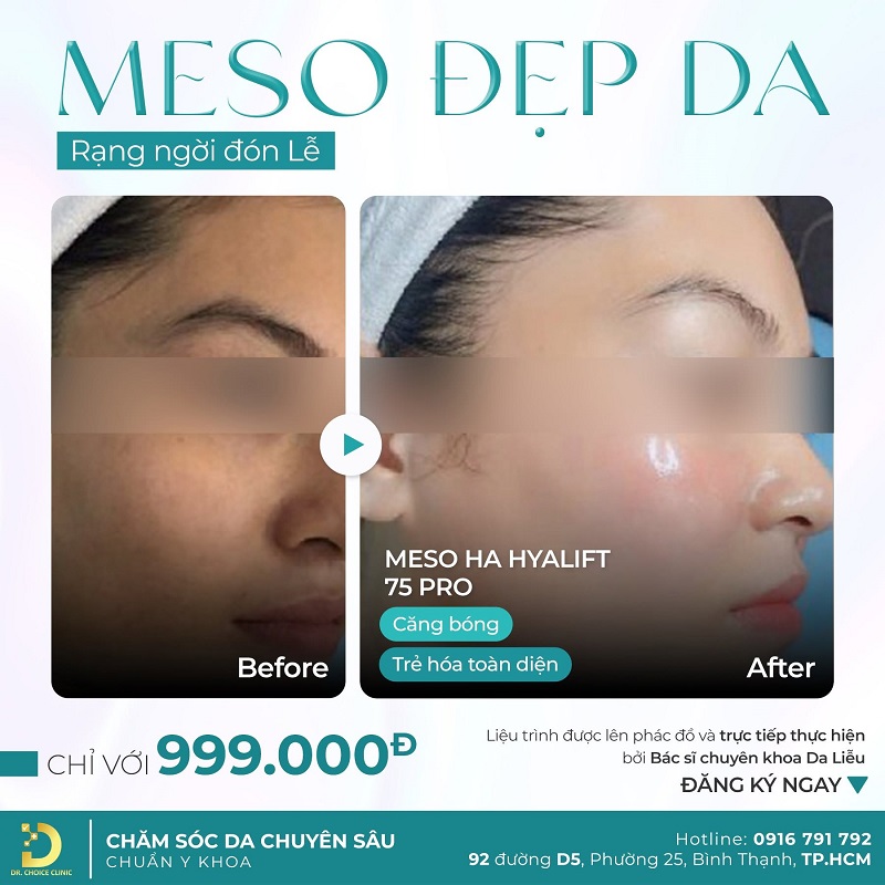 Mesotherapy Điều Trị Da Là Gì? Đặc Điểm, Ứng Dụng & Lưu Ý 14 meso da tai drchoice