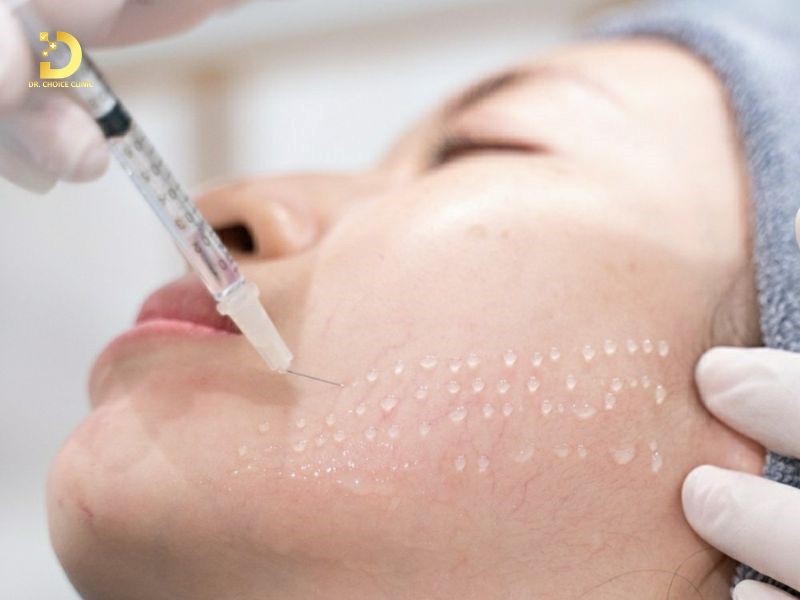 Mesotherapy Điều Trị Da Là Gì? Đặc Điểm, Ứng Dụng & Lưu Ý 10 Mesotherapy điều trị da (ảnh minh họa)