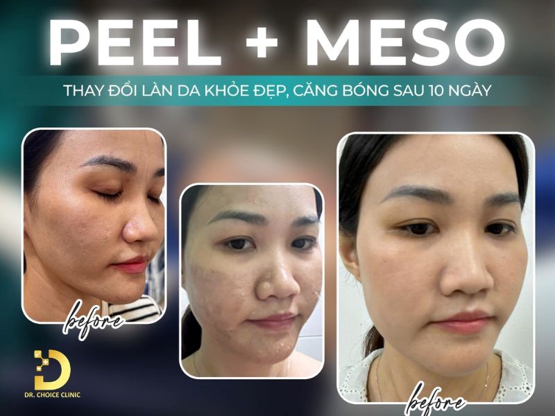 Tiêu Chí Lựa Chọn Spa Chăm Sóc, Điều Trị Da 25 Feedback của khách hàng sử dụng dịch vụ peel + meso da.