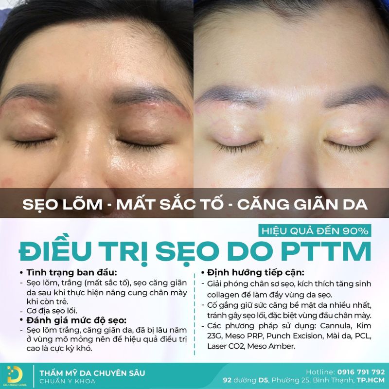 Tiêu Chí Lựa Chọn Spa Chăm Sóc, Điều Trị Da 20 Dịch vụ điều trị sẹo do phẫu thuật thẩm mỹ.