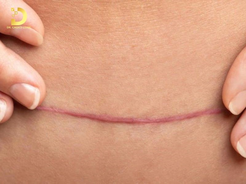 Vết Sẹo Mổ Đẻ Bị Lồi: Nguyên Nhân & Cách Điều Trị Hiệu Quả 9 Sẹo lồi mổ đẻ (ảnh minh họa)