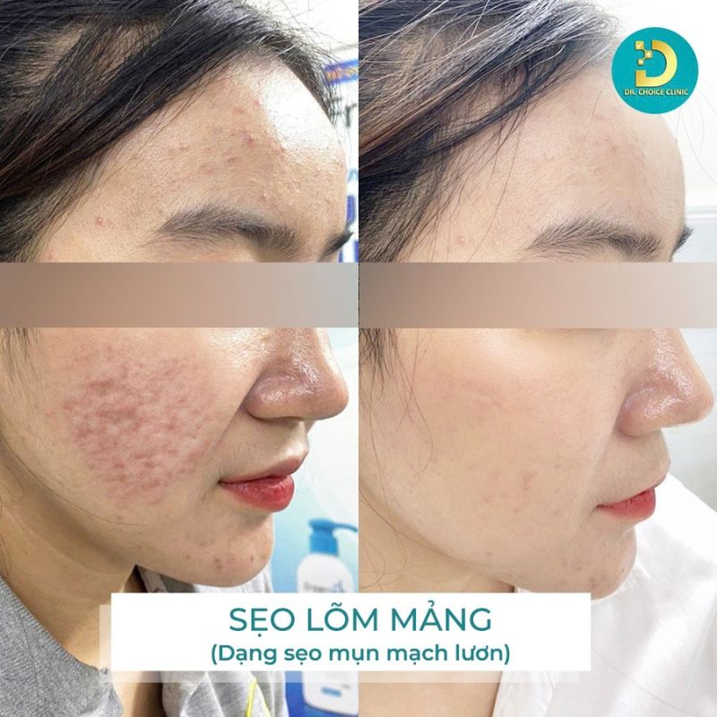 Tiêu Chí Lựa Chọn Spa Chăm Sóc, Điều Trị Da 23 Hình ảnh feedback điều trị sẹo lõm mảng.