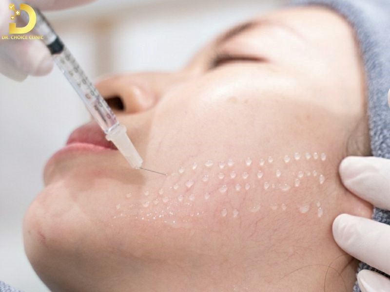 So Sánh Tiêm BAP Và Meso: Nên Chọn Phương Pháp Nào? 9 Tiêm Meso (ảnh minh họa)