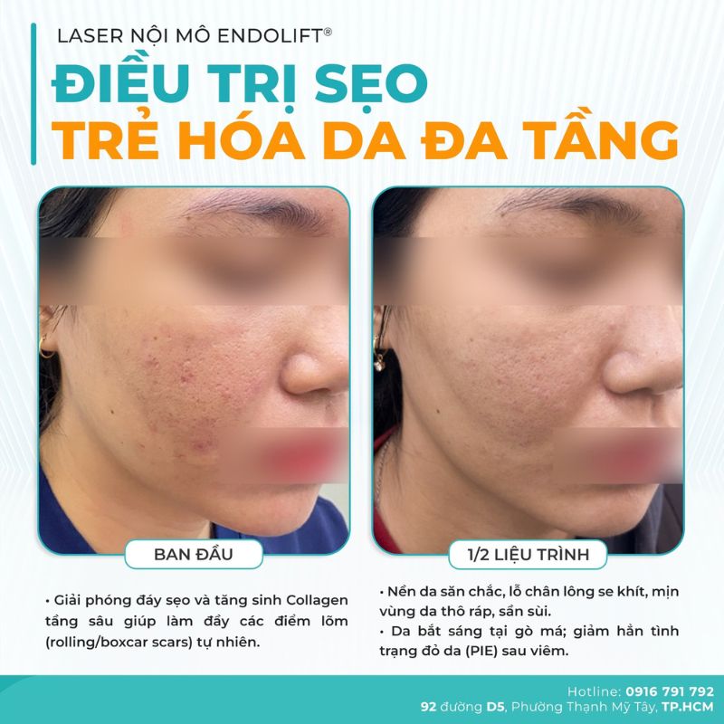 Tiêu Chí Lựa Chọn Spa Chăm Sóc, Điều Trị Da 21 Hình ảnh feedback trước và sau khi laser nội mô tại Dr. Choice Clinic
