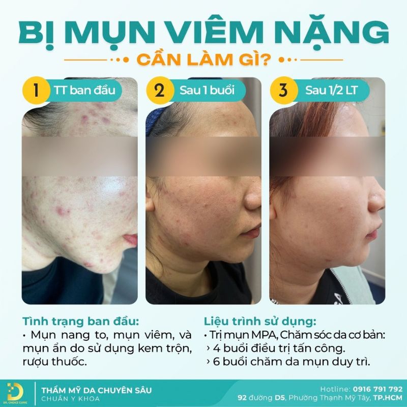 Tiêu Chí Lựa Chọn Spa Chăm Sóc, Điều Trị Da 22 Liệu trình điều trị mụn viêm nặng.