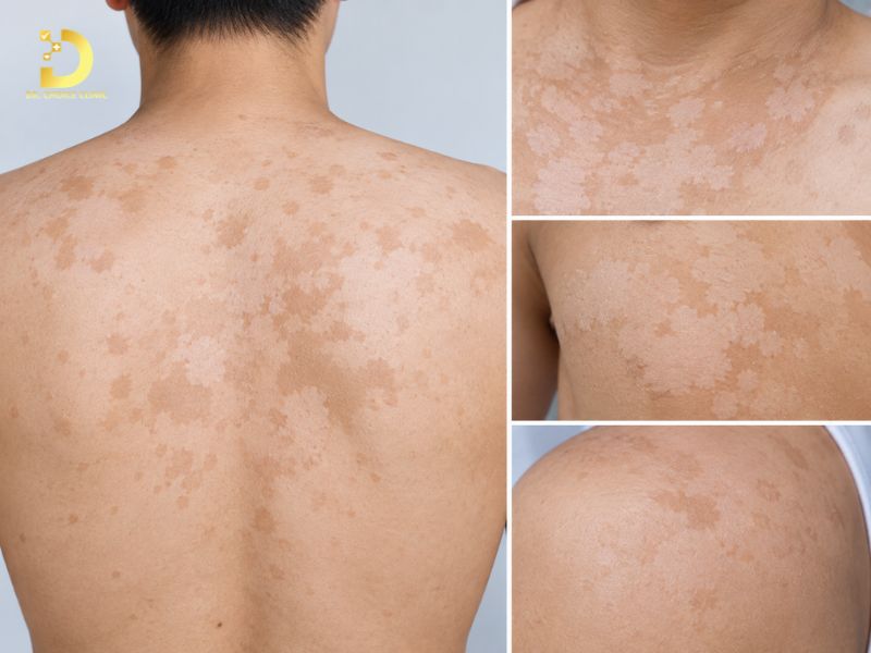 Top 15 Bệnh Ngoài Da Thường Gặp & Cách Phòng Tránh Hiệu Quả 22 Lang ben