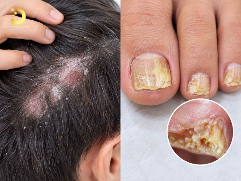 Top 15 Bệnh Ngoài Da Thường Gặp & Cách Phòng Tránh Hiệu Quả 23 Nấm da đầu/Nấm móng
