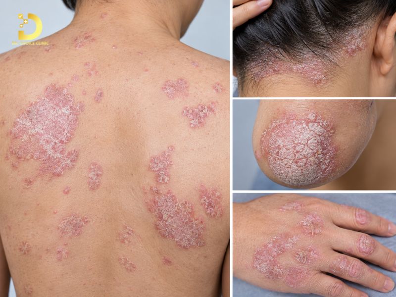 Top 15 Bệnh Ngoài Da Thường Gặp & Cách Phòng Tránh Hiệu Quả 31 Vảy nến (Psoriasis)